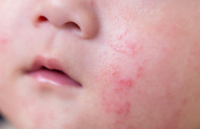 infants Eczema