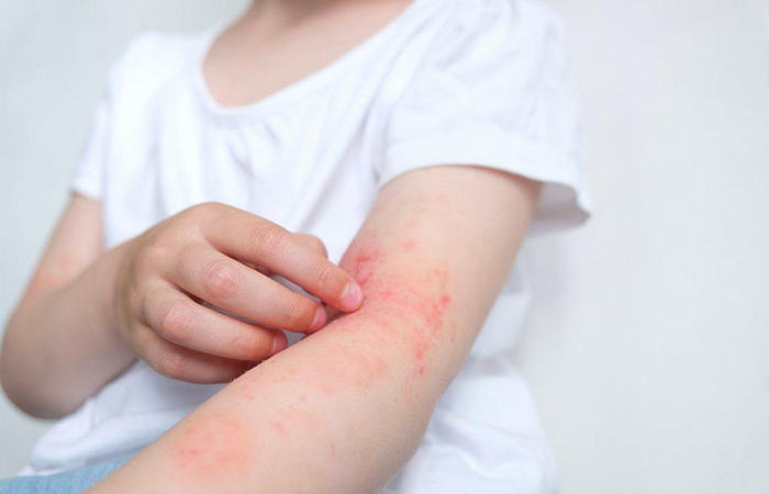 child Eczema effect
