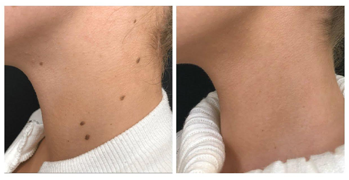 Before and After Mole Monitoring