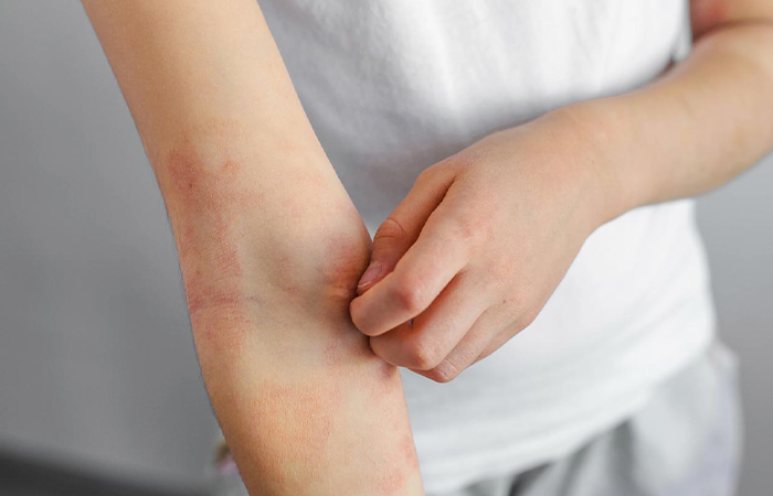 adolescents Eczema