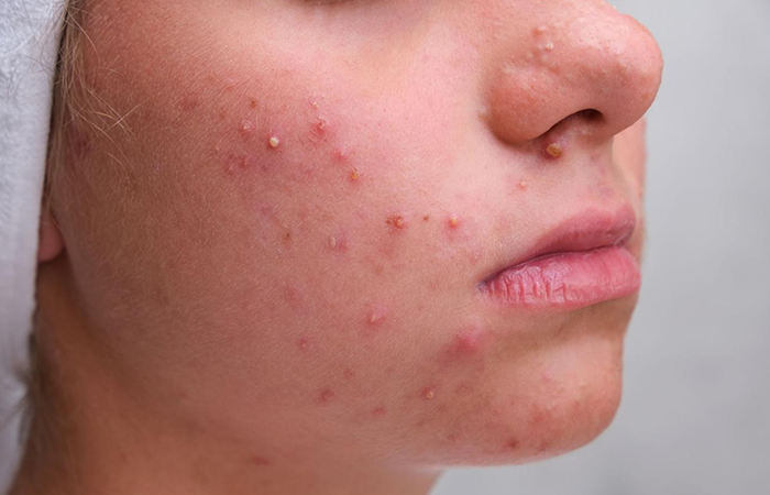 Acne in Adolescents
