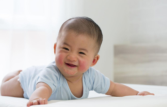 Allergic Reactions in Infants
