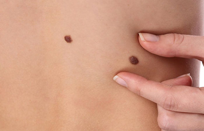  Birthmarks Disorders

