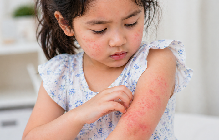 Allergic Reactions in Children