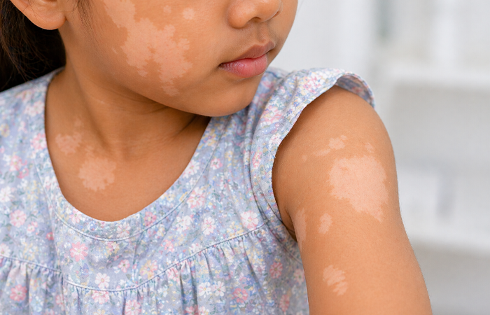  Pigmentation Disorders in Children

