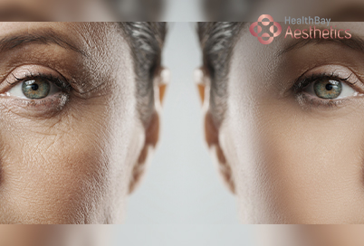 BBL HEROic™ skin rejuvenation