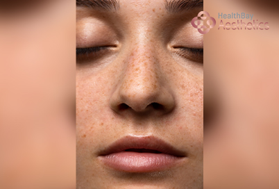 Melasma Treatment