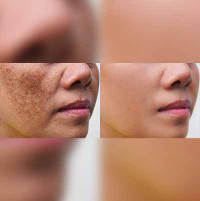 Spectra Laser Treatment