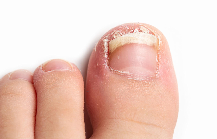 Nail Disorders