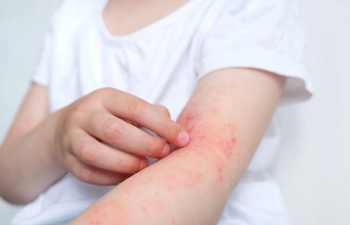 Allergic Skin Reactions