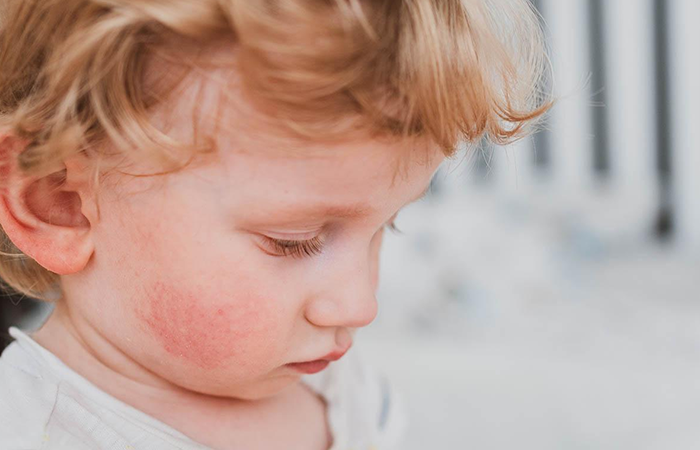 Child Skin Infections