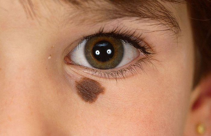 Child Birthmarks