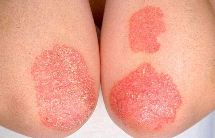 Psoriasis in Children width=