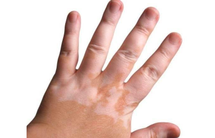 Child Vitiligo