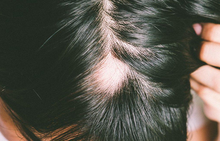 Hair and Scalp Disorders