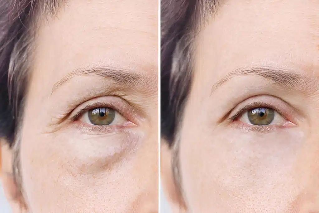 Sunekos skin rejuvenation treatment