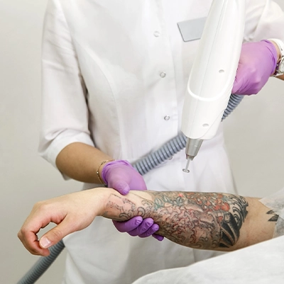 Tattoo Removal at HealthBay Aesthetics