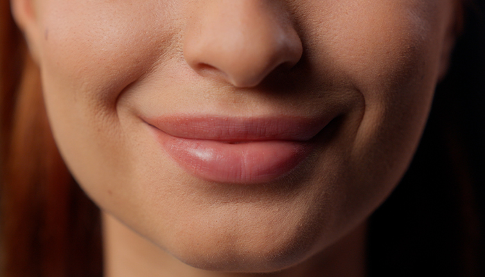 Lips after Lip Fillers