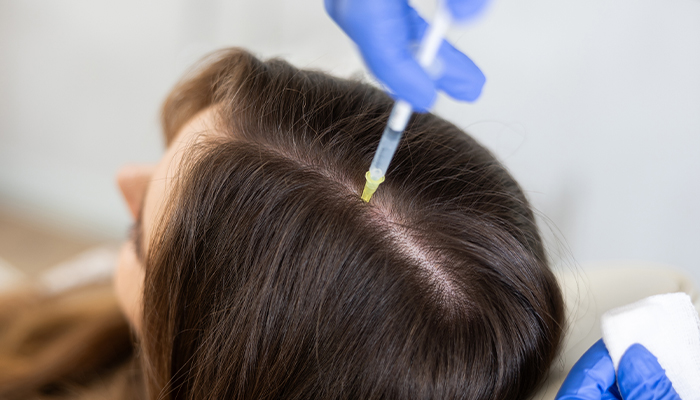 PRP Hair Loss Treatment