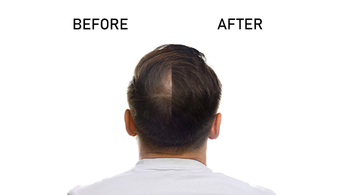Before and After PRP Hair Treatment