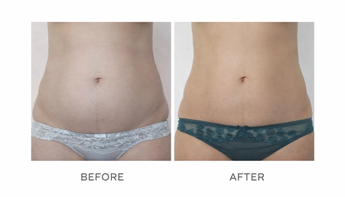 Before & After of Body Sculpting Treatment