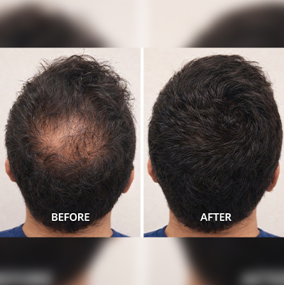 Tricopat Hair Restoration