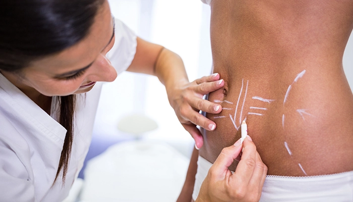 Doctor preparing patient for surgical body sculpting treatment
