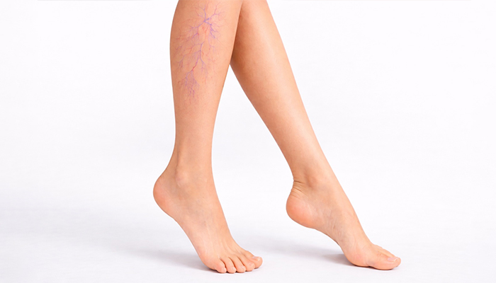 Spider Vein 
