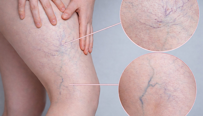 Causes of Spider Veins
