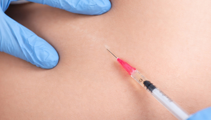 Microneedling treatment for scar removal