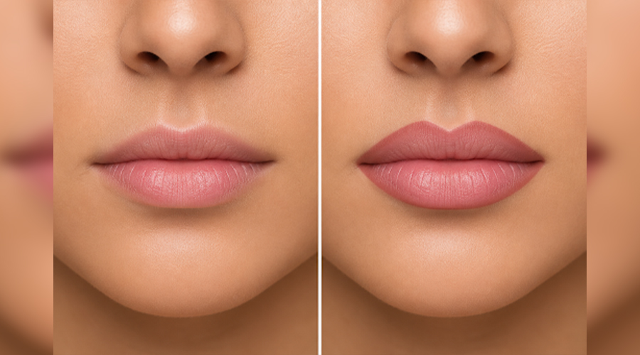 Lip Contouring

