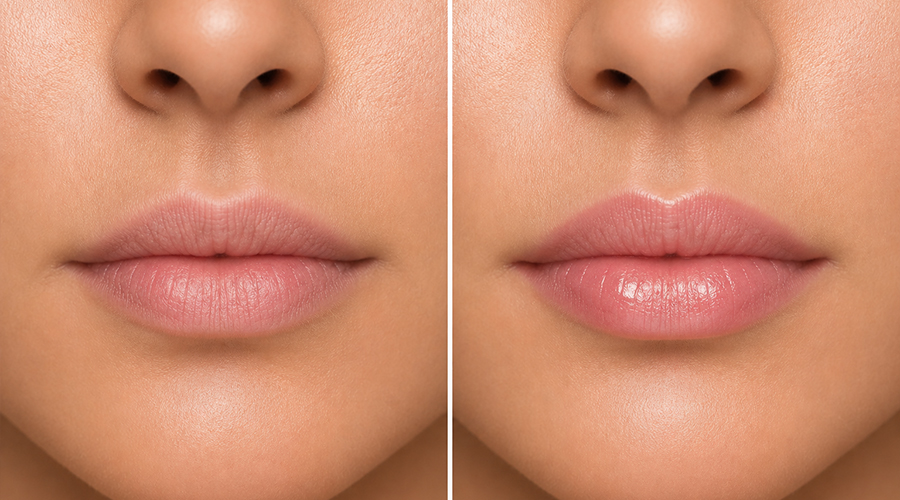 Lip Volume Enhancement
